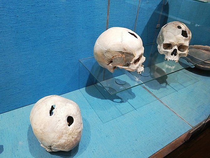 Lebky s dírami po trepanaci. Ostatky pocházejí z doby bronzové, nalezeny byly ve Francii. Ilustrační foto