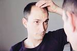 Alopecií trpí v Česku tisíce lidí.