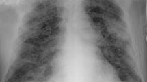 Rentgen hrudníku s pneumonií způsobenou COVID-19