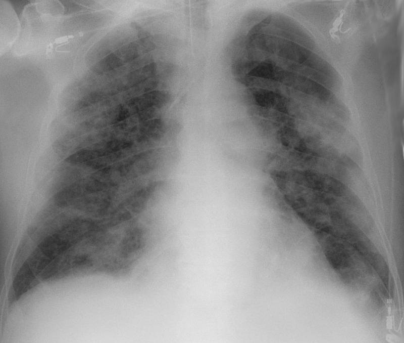 Rentgen hrudníku s pneumonií způsobenou COVID-19