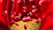 Tělo člověka si hypercholesterolemii už od malička neví rady s cholesterolem a ten se nebezpečně ukládá v cévách.