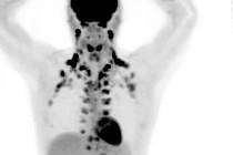 Snímky z pozitronové emisní tomografie ukazují rozdíl mezi těly s velkým podílem hnědého tuku (vlevo) a s jeho nedostatkem