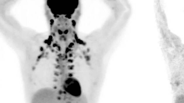 Snímky z pozitronové emisní tomografie ukazují rozdíl mezi těly s velkým podílem hnědého tuku (vlevo) a s jeho nedostatkem