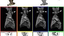 CT sken kostního výčnělku.
