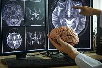Nový nástroj AI možná bude v budoucnu užitečným pomocníkem v léčbě rakoviny mozku. Ilustrační snímek