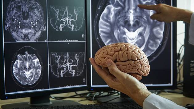 Nový nástroj AI možná bude v budoucnu užitečným pomocníkem v léčbě rakoviny mozku. Ilustrační snímek