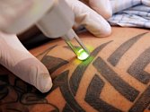 Odstranění tetování přijde podle rozsahu na stovky až několik tisíc korun. Ilustrační foto.