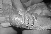 Detailní pohled na léze pravděpodobně opičích neštovic na paži a noze čtyřleté africké holčičky. Snímek byl pořízen v lednu 1971 v Libérii. Infekci způsobil vir neštovic typu vakcinie, variola nebo právě opičí neštovice
