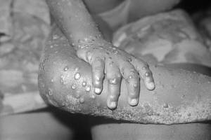 Detailní pohled na léze pravděpodobně opičích neštovic na paži a noze čtyřleté africké holčičky. Snímek byl pořízen v lednu 1971 v Libérii. Infekci způsobil vir neštovic typu vakcinie, variola nebo právě opičí neštovice