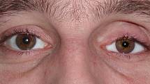3. Přímý pohled již s oční protézkou.
