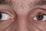 4. Pohled doprava s protézkou. Barvy oční protézky umí protetici udělat perfektně podle druhého oka.