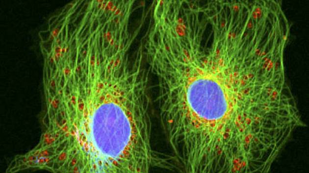 Rakovinné buňky s průměrem okrouhlých jader asi 12 mikrometrů ve speciálním mikroskopu na zkoumání živých buněk. Ilustrační foto.