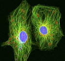 Rakovinné buňky s průměrem okrouhlých jader asi 12 mikrometrů ve speciálním mikroskopu na zkoumání živých buněk. Ilustrační foto.