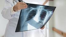 U plicního lékaře proběhne spirometrie, rentgen hrudníku a následně, zda máte CHOPN a jaké je její stadium.