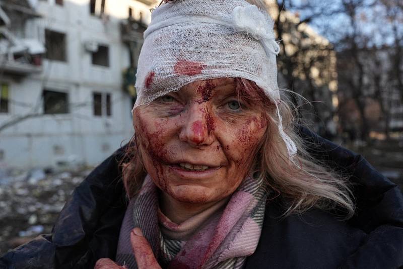 Ruská invaze na Ukrajinu (město Čuhujiv, 24. února 2022). Zraněná Ukrajinka v charkovské oblasti po raketovém útoku. Fotografie obletěla svět
