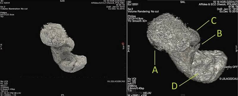 Zobrazení plodu v těle staroegyptské mumie za pomoci výpočetní tomografie (CT)