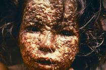 Dítě z Bangladéše nakažené pravými neštovicemi.