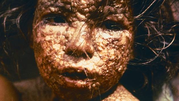 Dítě z Bangladéše nakažené pravými neštovicemi.