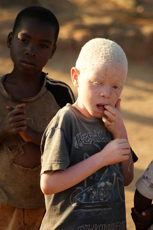 Malawi je také jednou ze zemí, kde jsou ve velkém pronásledováni a zabíjeni albíni. Místní věří, že jejich části těla mohou léčit a nosí štěstí