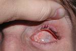 2. Pasivně otevřená oční štěrbina bez oka.