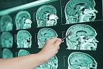 Mozky byly z hlavy vyjmuty často bez souhlasu pacienta či jeho rodiny