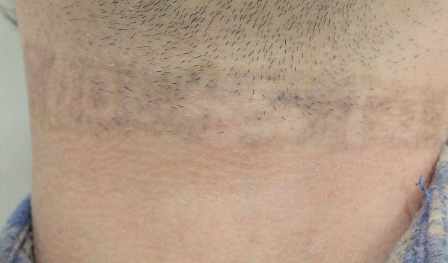 Tetování na krku po odstranění laserem.