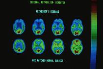 Počítačový scan mozku stiženého Alzheimerovou chorobou.