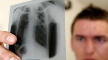 V Česku na rakovinu průdušek a plic zemře ročně kolem 4000 mužů a téměř 1500 žen.  