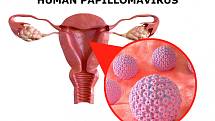 S HPV infekcí (původce rakoviny děložního čípku) se setká asi 80 procent sexuálně aktivních osob, ale často ji zlikviduje vlastní imunita.