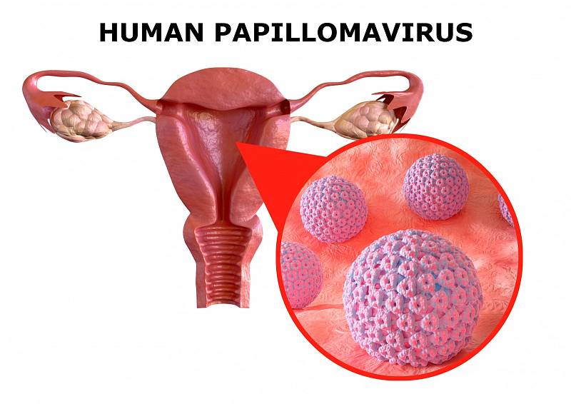 S HPV infekcí (původce rakoviny děložního čípku) se setká asi 80 procent sexuálně aktivních osob, ale často ji zlikviduje vlastní imunita.