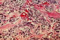 Histologický snímek rakovinné prsní tkáně. Růžově zbarvené toky představují normální pojivovou tkáň, tmavě jsou zbarveny rakovinné buňky