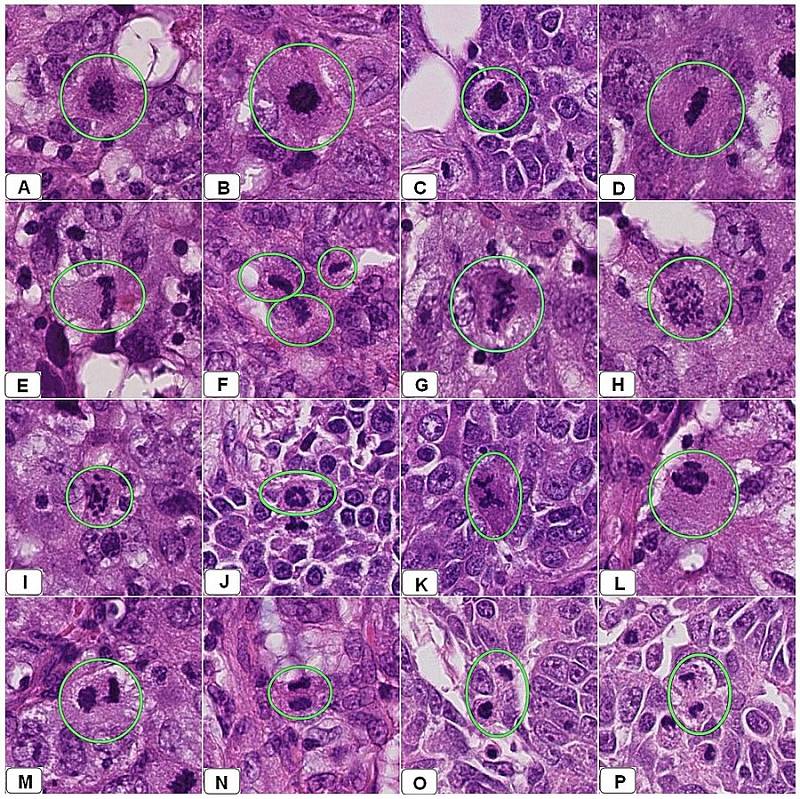 Snímky z několika resekcí prsu za účelem odstranění rakovinného nádoru.  Snímky A až C ukazují buňky v rané metafázi, snímky D až G různé formy mitotického dělení v pozdní metafázi, snímky H až L různé formy anafáze, snímky M až P buňky v telofázi
