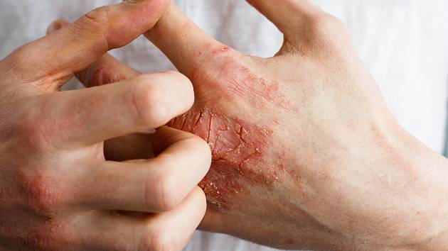 V České republice žije s atopickou dermatitidou přes 230 tisíc lidí.