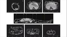 CT snímky obrysů lidské postavy v bahenním krunýři. Ten je na snímcích vyznačen bílou čarou