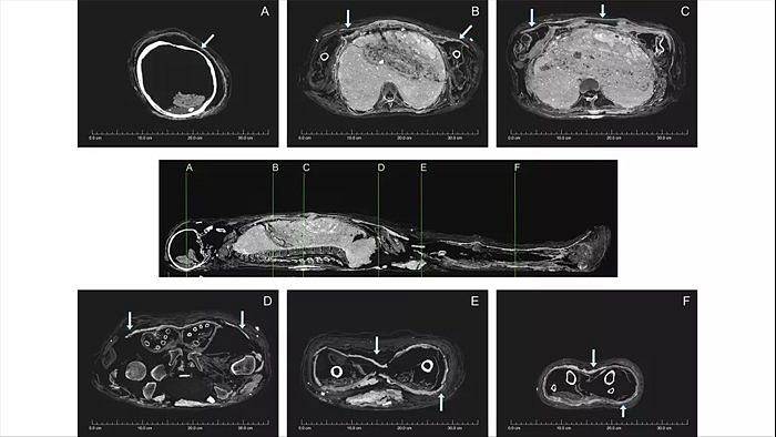 CT snímky obrysů lidské postavy v bahenním krunýři. Ten je na snímcích vyznačen bílou čarou