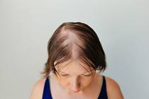 Řešením při androgenní alopecii je včasné blokování dihydrotestosteronu (DHT), který způsobuje postupné zmenšování vlasových folikul. V opačném případě vlasy rostou stále tenčí a kratší až jednoho dne nevyrostou vůbec.