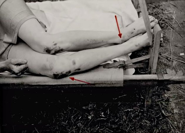 Jedna šipka ukazuje odřeniny na kolenou Hildegardy Hudcové, druhá zlomeninu v levém kotníku