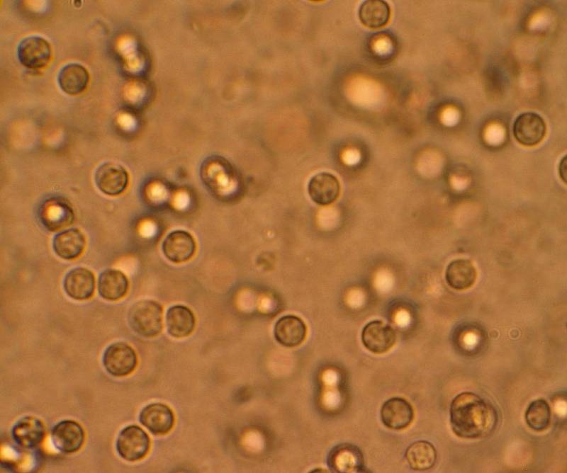 Bílé krvinky pozorované pod mikroskopem ze vzorku moči
