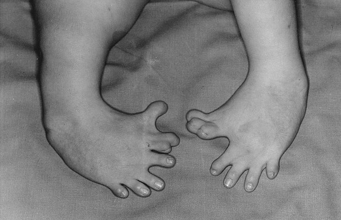 Vrozená vada chodidel dítěte po užívání thalidomidu matkou v těhotenství.