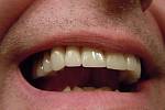 Naděje pro nemocné či po úrazu. Vědci v Japonsku informovali o objevu, který by mohl umožnit opětovný růst zubů. 