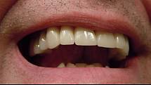 „Konvenční tkáňové inženýrství není vhodné pro regeneraci lidských zubů. Naše studie ale ukázala, že nebuněčná molekulární terapie by mohla být účinná v širokém rozsahu vrozených zubních vad a ortodontických anomálií,“ říká spoluautor studie Manabu Sugai.