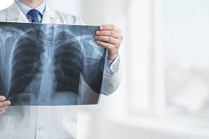 Podle odborníků může až 450 tisíc jedinců v České republice žít se zatím nediagnostikovanou chronickou obstrukční plicní nemocí.