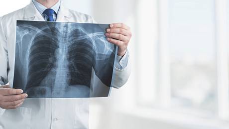 Podle odborníků může až 450 tisíc jedinců v České republice žít se zatím nediagnostikovanou chronickou obstrukční plicní nemocí.