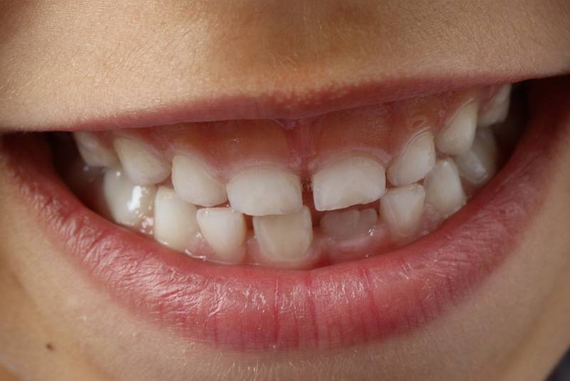 Jak zabránit tomu, aby už děti měly zkažené zuby? Podle Lukáše Kaloše je nejdůležitější prevence. „To znamená naučit rodiče čistit zuby a starat se o vlastní orální zdraví,“ vysvětluje.