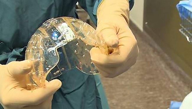 Poprvé byla lidská lebka nahrazena na míru vytištěnou protézou z plastu