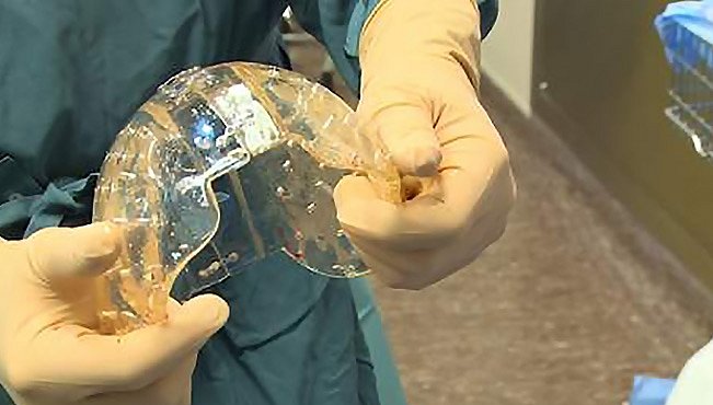 Poprvé byla lidská lebka nahrazena na míru vytištěnou protézou z plastu