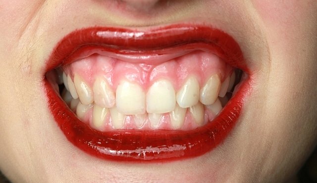 Místo skloviny by zuby mohl chránit lak. Pracují na něm v Brně