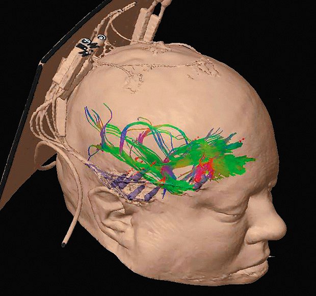 Grafika znázorňuje umístění elektrod a detekovanou aktivitu mozku.