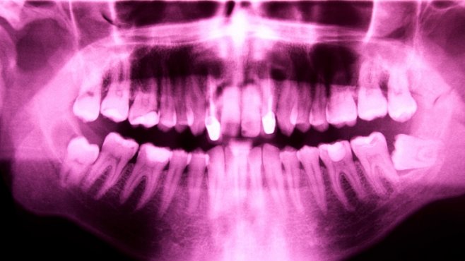 Za nádory na mozku mohou rentgeny zubů, naznačuje studie