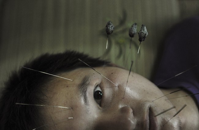Pacient trpící ochrnutím obličejových svalů se podrobuje léčbě akupunkturou ve městě Jiaxing ve východní Číně.